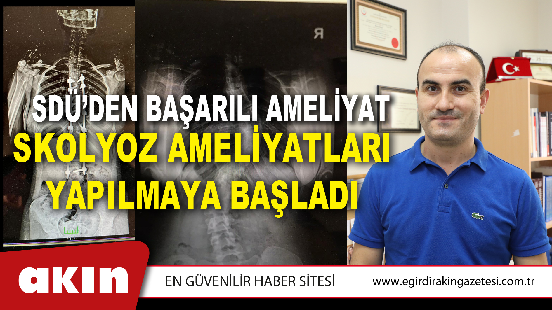 SDÜ’DEN BAŞARILI AMELİYAT