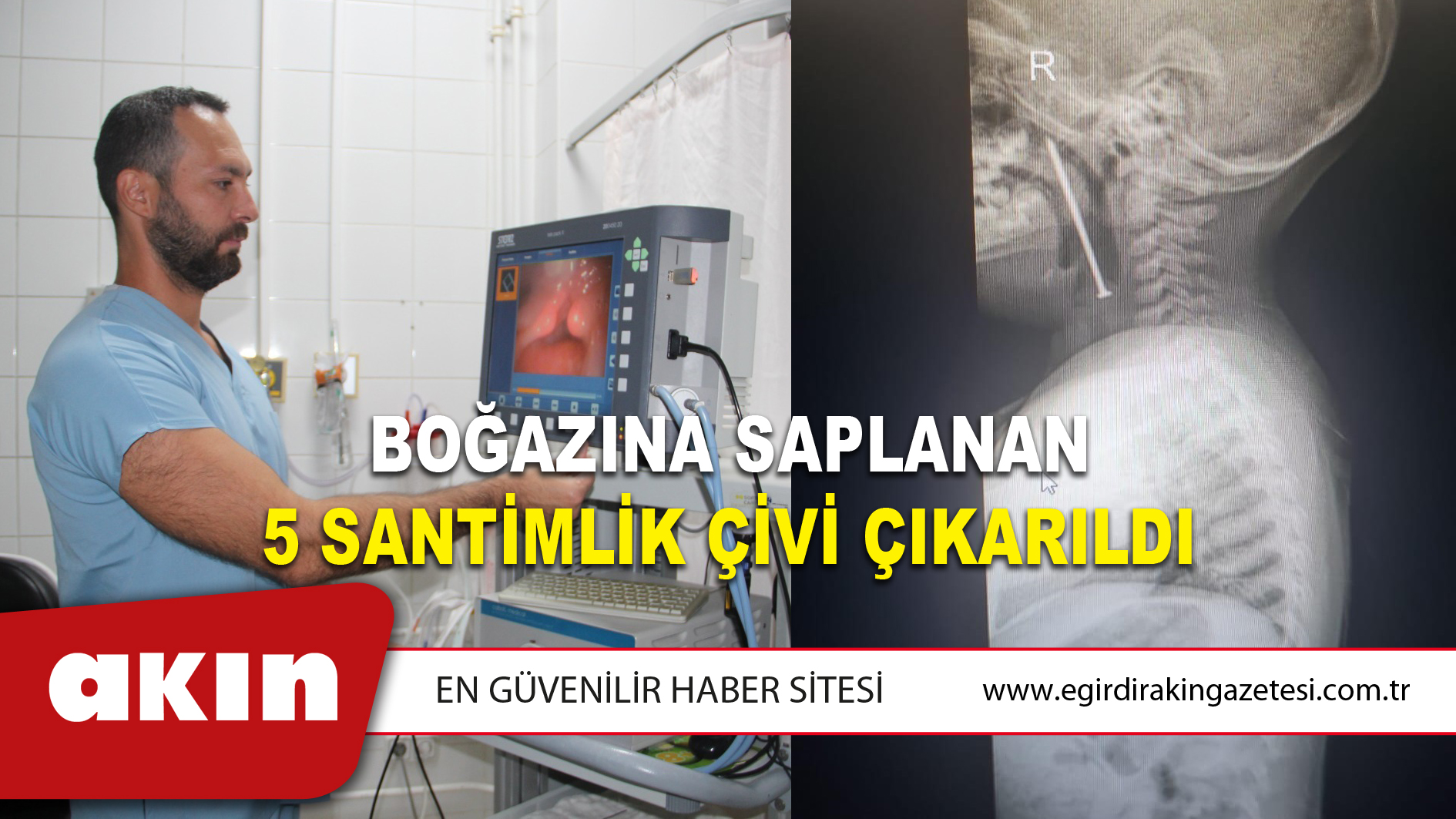 Boğazına Saplanan 5 Santimlik  Çivi Çıkarıldı