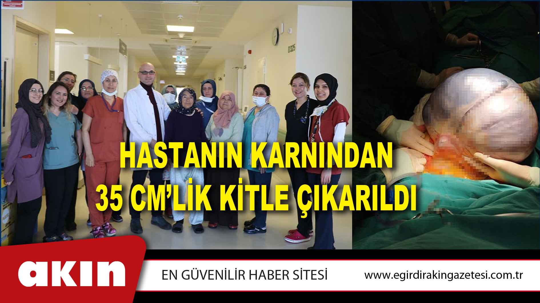 eğirdir haber,akın gazetesi,egirdir haberler,son dakika,Hastanın Karnından 35 Cm’lik Kitle Çıkarıldı